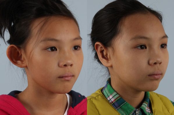 before and after otoplasty right angle view female patient case 1648