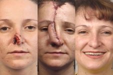 before and after rhinoplasty female patient front view case 3593