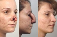 before and after rhinoplasty female patient right diagonal view case 3593
