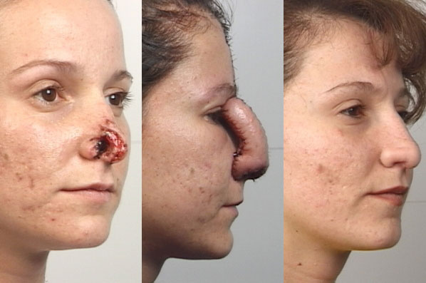 before and after rhinoplasty female patient right diagonal view case 3593