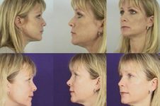 before and after rhinoplasty female patient multiple angle view case 3597