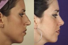 before and after rhinoplasty female patient right side view case 3604