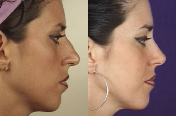 before and after rhinoplasty female patient right side view case 3604