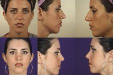 before and after rhinoplasty female patient multiple angle view case 3604