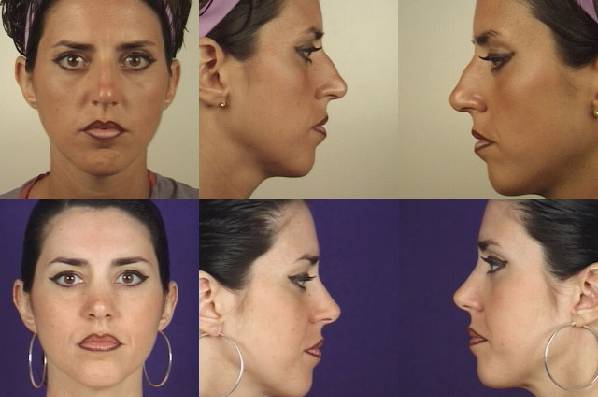 before and after rhinoplasty female patient multiple angle view case 3604