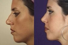 before and after rhinoplasty female patient left side view case 3604