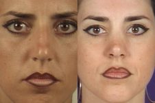 before and after rhinoplasty female patient front view case 3604
