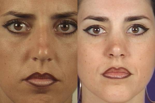 before and after rhinoplasty female patient front view case 3604