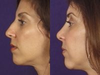 before and after rhinoplasty female patient left side view case 3609