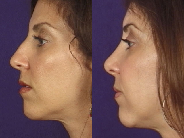 before and after rhinoplasty female patient left side view case 3609