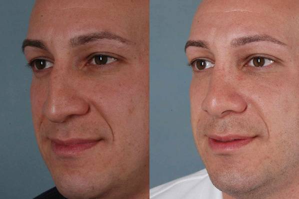 before and after rhinoplasty female patient left diagonal view case 3612