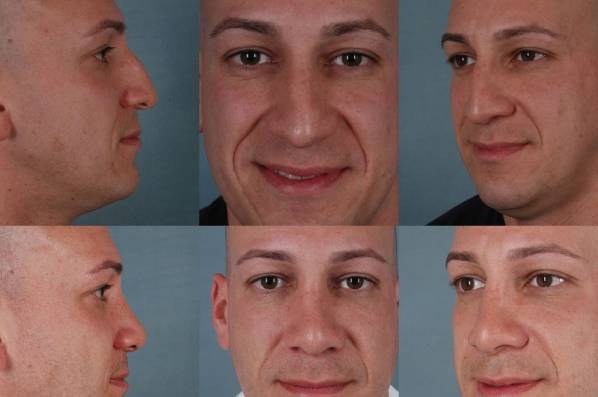 before and after rhinoplasty male patient multiple angle view case 3612