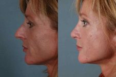 before and after rhinoplasty female patient left side view case 3615
