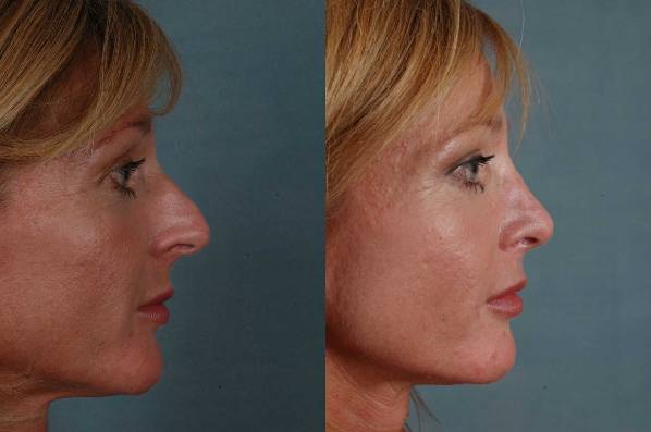 before and after rhinoplasty female patient right side view case 3615