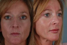 before and after rhinoplasty female patient multiple angle view case 3615