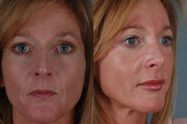 before and after rhinoplasty female patient multiple angle view case 3615