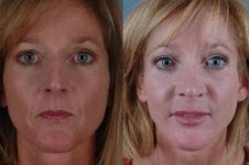 before and after rhinoplasty female patient front view case 3615