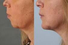 before and after rhinoplasty female patient left side view case 3620