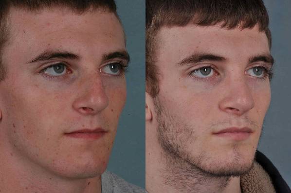 before and after rhinoplasty male patient right diagonal view case 3623