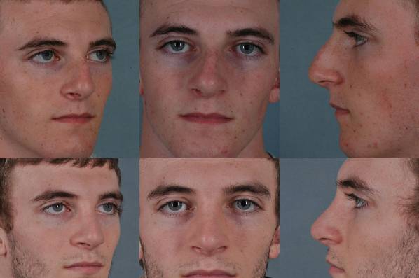 before and after rhinoplasty male patient multiple angle view case 3623