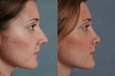 before and after rhinoplasty female patient right side view case 3627