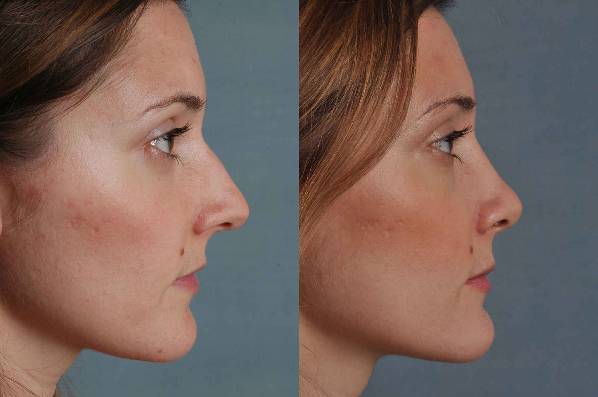 before and after rhinoplasty female patient right side view case 3627