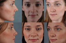 before and after rhinoplasty female patient multiple angle view case 3627