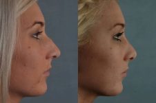 before and after rhinoplasty female patient right side view case 3630