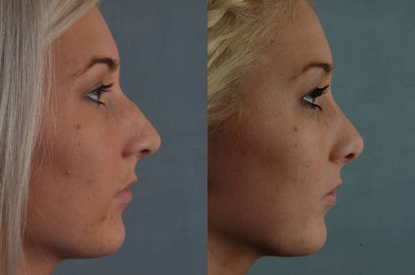 before and after rhinoplasty female patient right side view case 3630