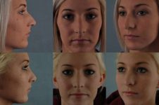 before and after rhinoplasty female patient multiple angle view case 3630