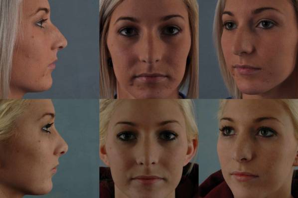 before and after rhinoplasty female patient multiple angle view case 3630