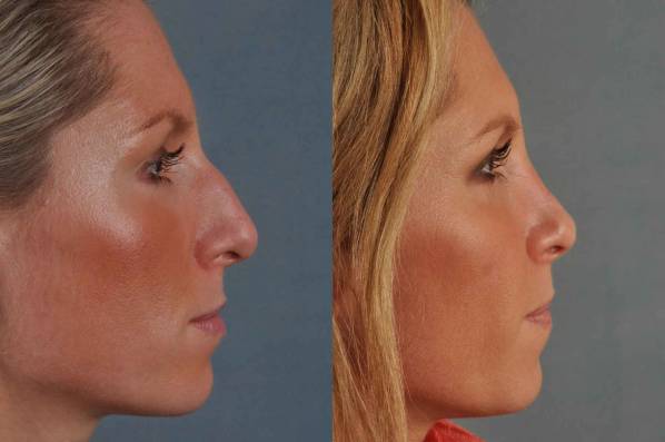 before and after rhinoplasty female patient right side view case 3638