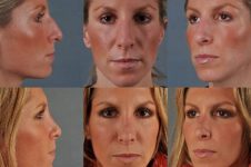 before and after rhinoplasty female patient multiple angle view case 3638