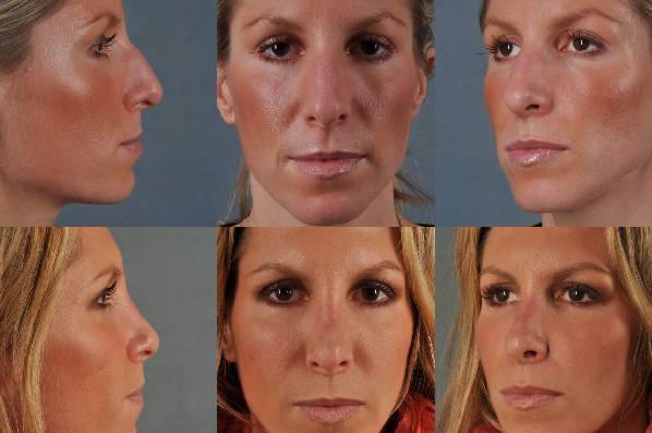 before and after rhinoplasty female patient multiple angle view case 3638