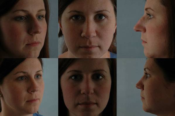before and after rhinoplasty female patient multiple angle view case 3642