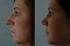 before and after rhinoplasty female patient left side view case 3642