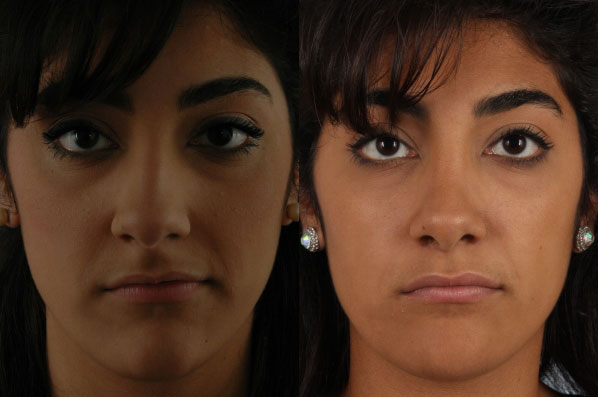before and after rhinoplasty female patient front view case 3645