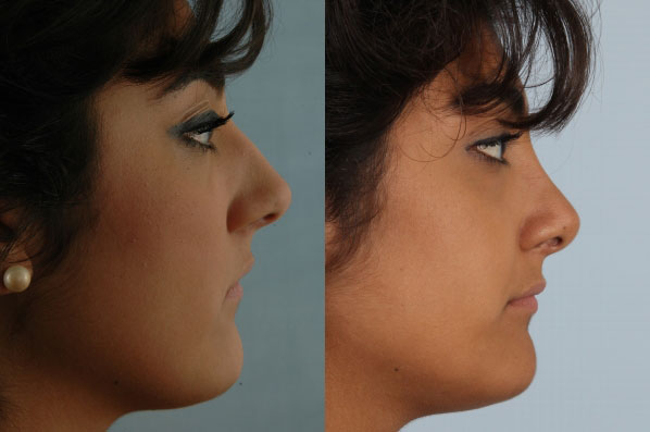 before and after rhinoplasty female patient right side view case 3645