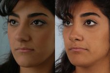 before and after rhinoplasty female patient left diagonal view case 3645