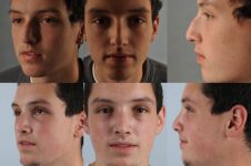 before and after rhinoplasty male patient multiple angle view case 3650