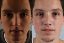 before and after rhinoplasty male patient front view case 3650
