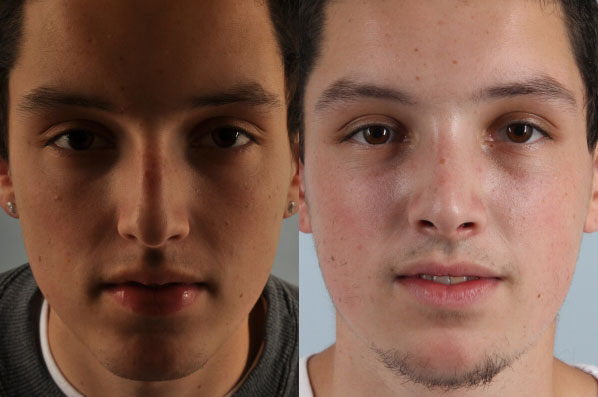 before and after rhinoplasty male patient front view case 3650
