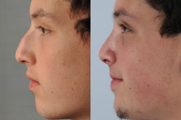 before and after rhinoplasty male patient left side view case 3650