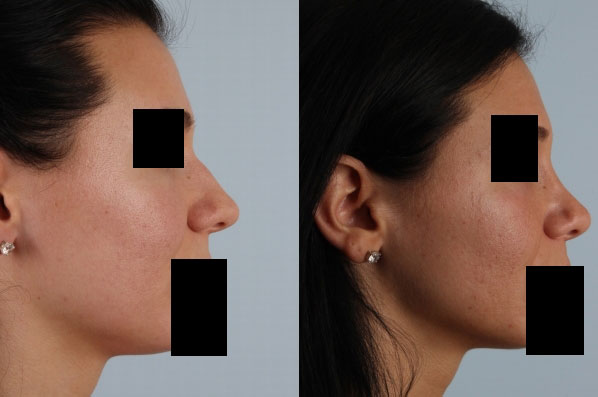 before and after rhinoplasty female patient right side view case 3654