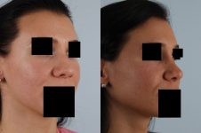 before and after rhinoplasty female patient right diagonal view case 3654