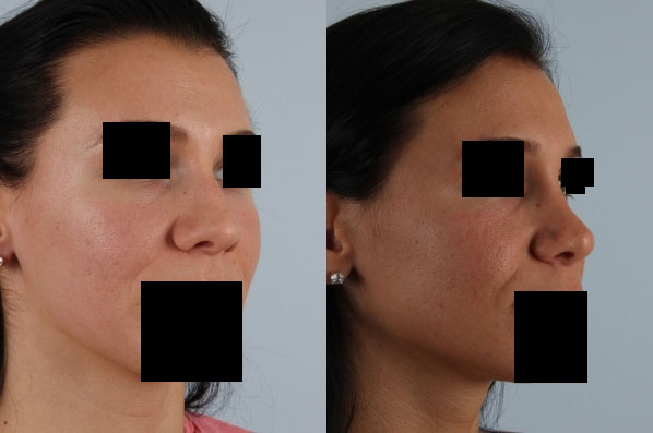 before and after rhinoplasty female patient right diagonal view case 3654