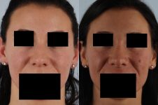 before and after rhinoplasty female patient front view case 3654