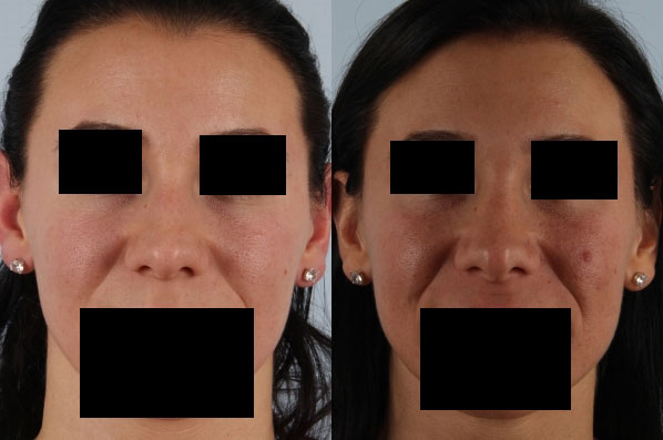 before and after rhinoplasty female patient front view case 3654