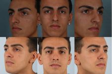 before and after rhinoplasty male patient multiple angle view case 3658