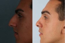 before and after rhinoplasty male patient left side view case 3658